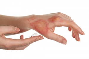 The way of use Skincol®